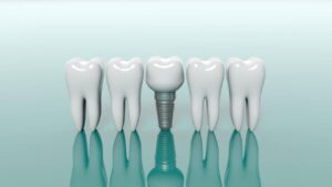 What Are the Three Types of Dental Implants