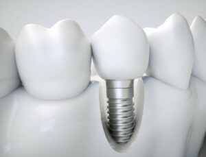 Why No Dairy After Dental Implant