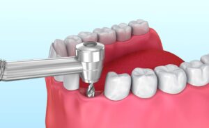 Are Dental Implants Safe