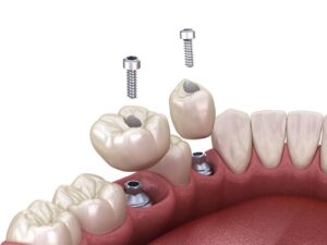 How Long Does a Dental Implant Procedure Take