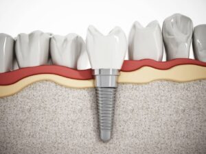 How Painful is a Dental Implant