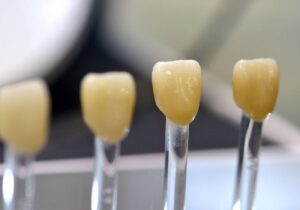 How is a Dental Crown Fitted