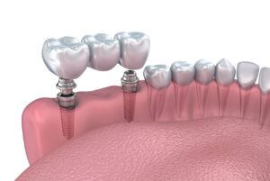 How is the Abutment Attached to an Implant