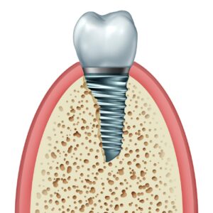 What Type of Maintenance Do Dental Implants Require