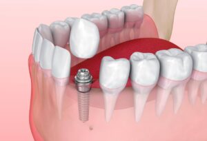 What are Dental Implants