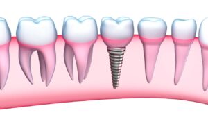 What is a Custom Fabricated Abutment for an Implant