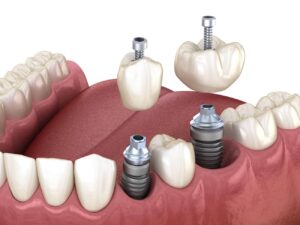 What is a Healing Abutment in Dental Implant Surgery