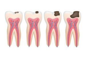 Can a Infected Tooth Make you Tired