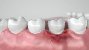 How to Treat Gingivitis