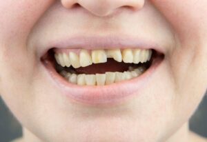 How Much Does It Cost To Fix A Chipped Tooth?