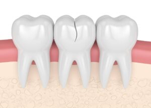 Does a Cracked Tooth Need to be Pulled?