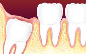 How Long Should Wisdom Tooth Pain Last?