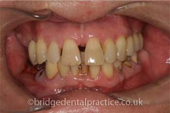 Implant with Bridge After