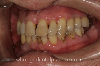 Implant with Bridge After