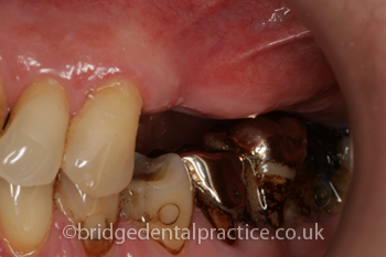 Implant with Bridge Before