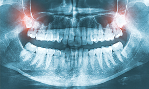 Extractions / Oral Surgery