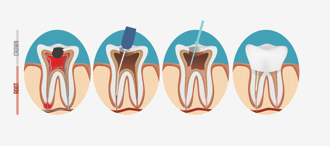 Root Canal Therapy