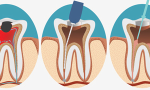 Root Canal Therapy