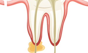 Root Canal Therapy