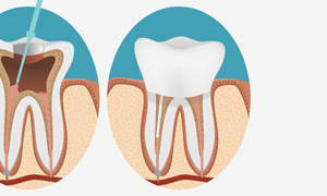 Root Canal Therapy