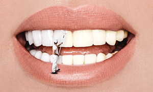 Teeth Whitening