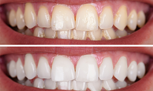 Teeth Whitening