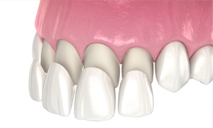 Veneers