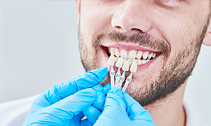 Veneers