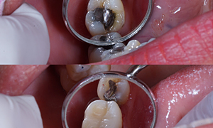 White Fillings
